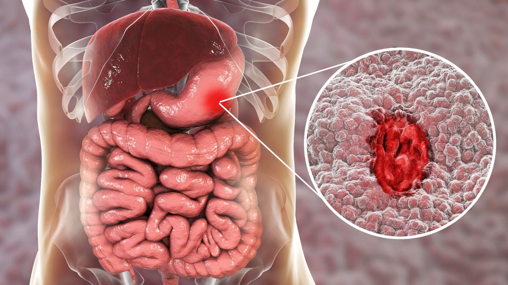 Inflammation of the stomach