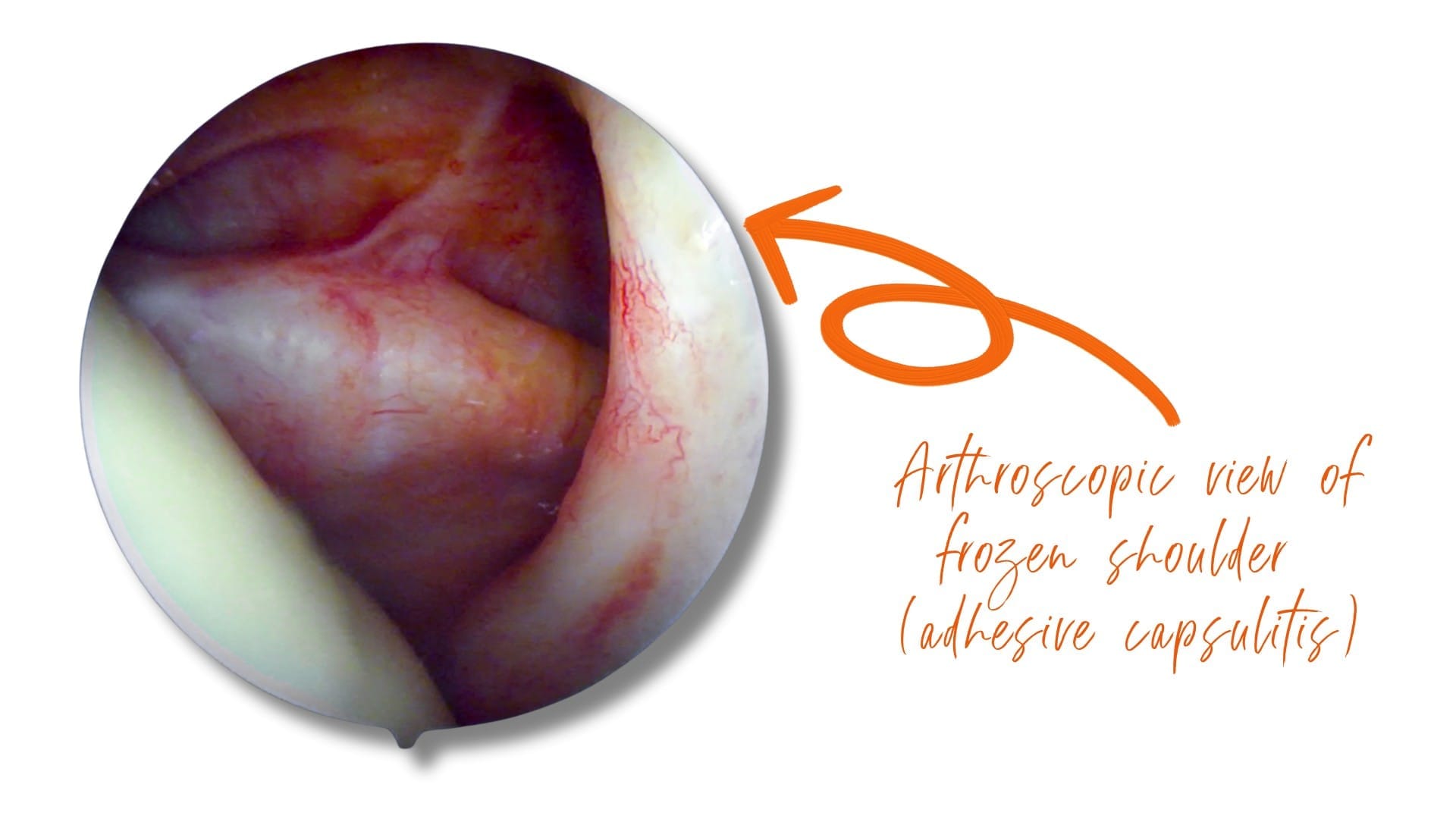 Shoulder capsule