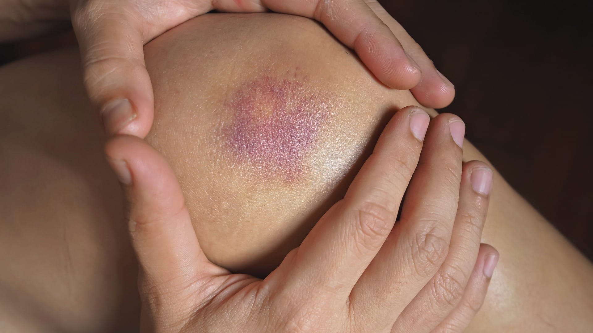 bruising