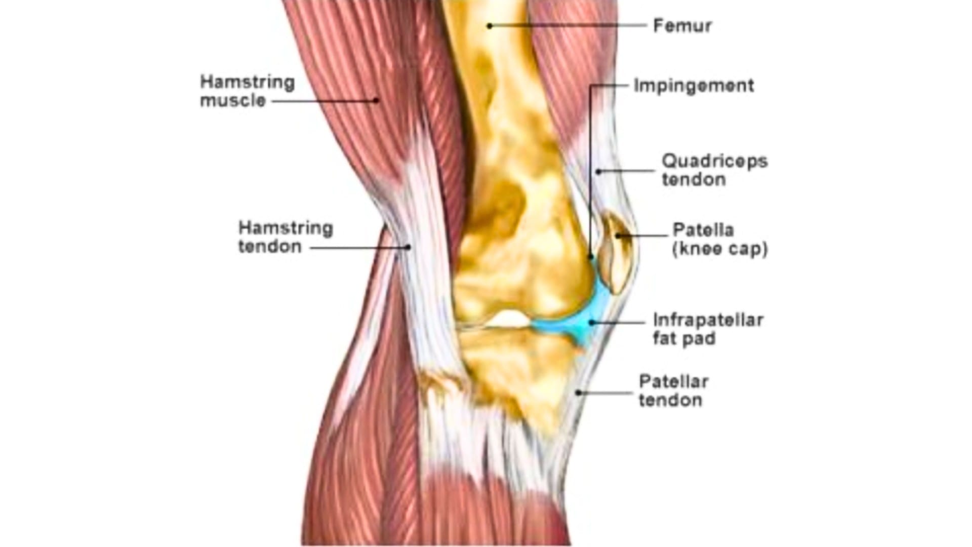 infrapatellar fat pad edema