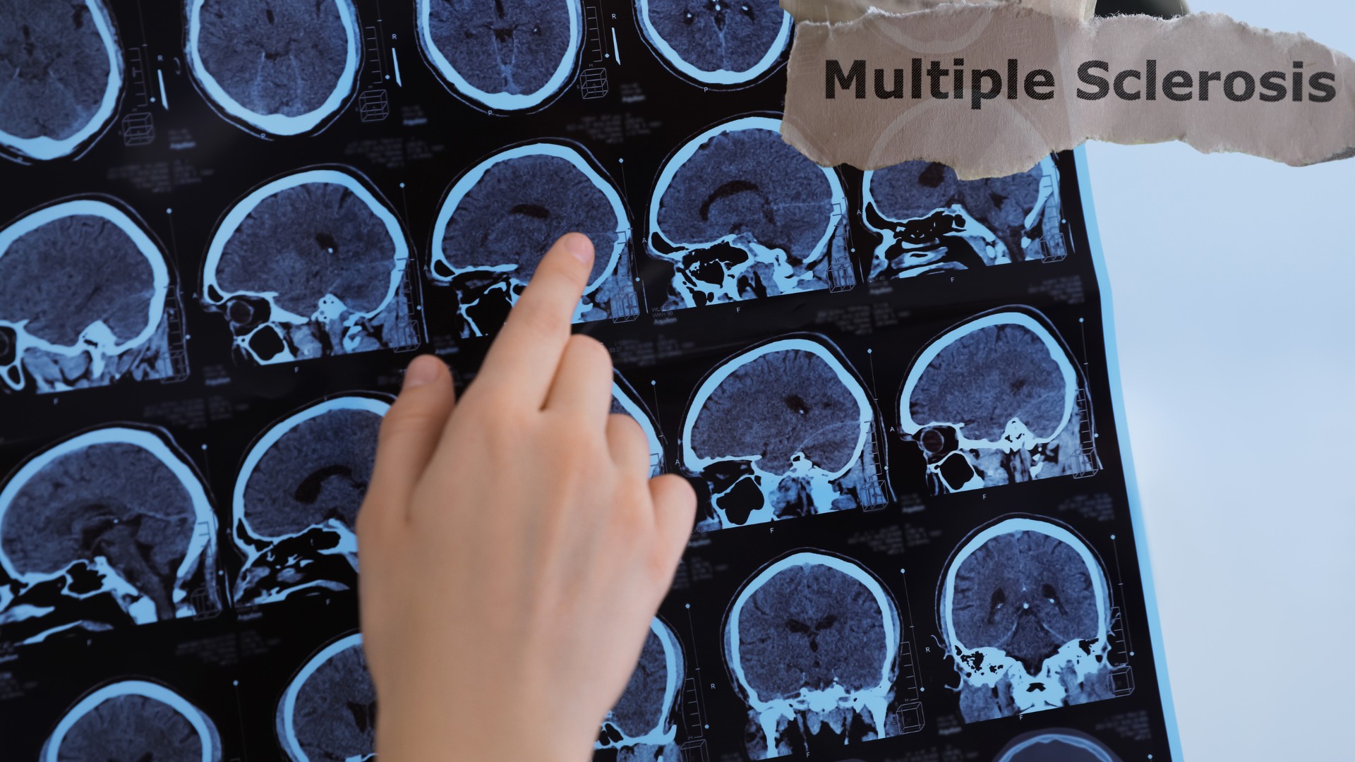 Fibromyalgia and MS