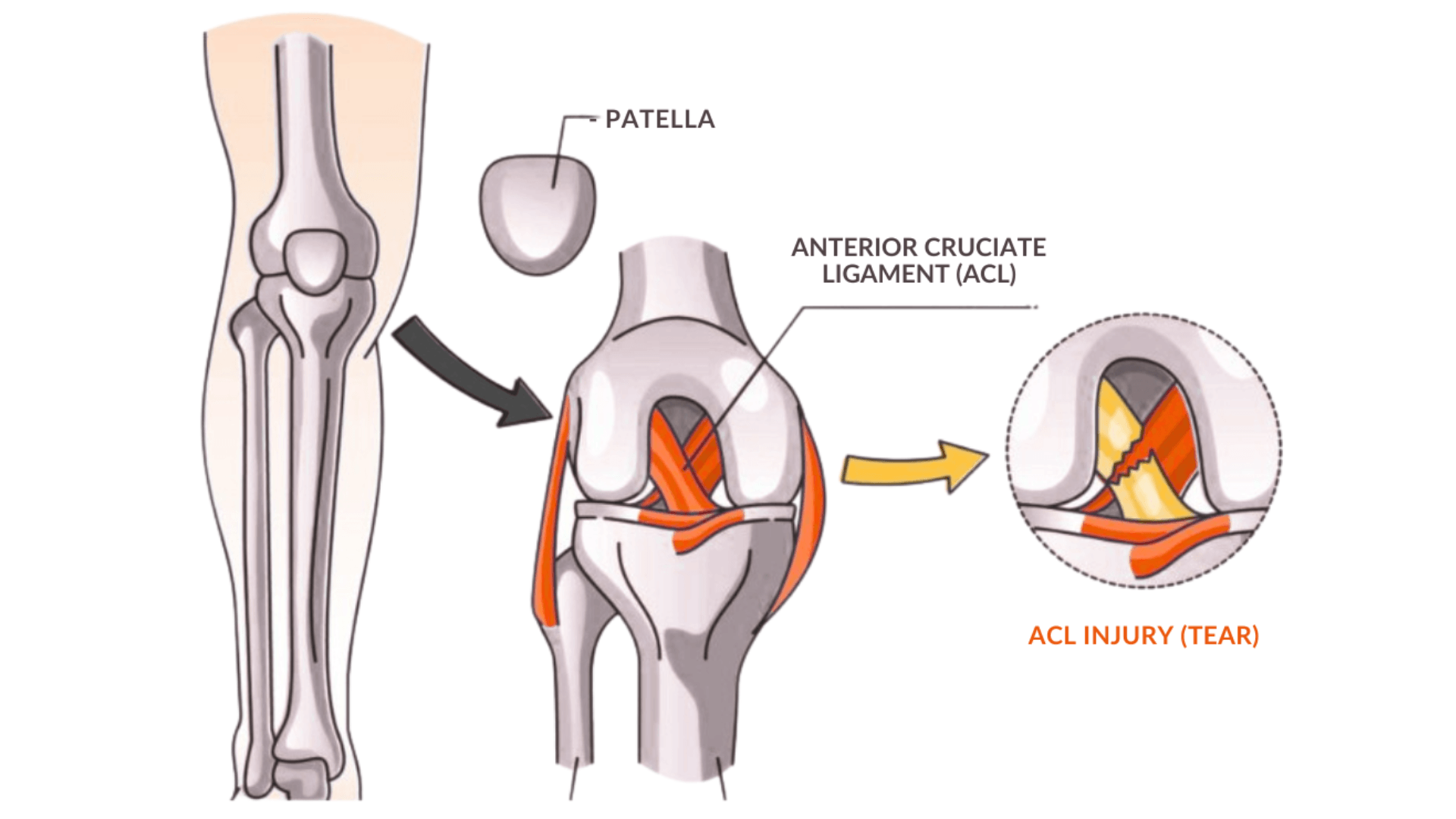 How Do ACL Injuries Happen